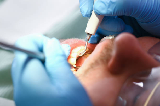 Best Emergency Treatment for Dental Infections or Abscesses in East Foothills, CA
